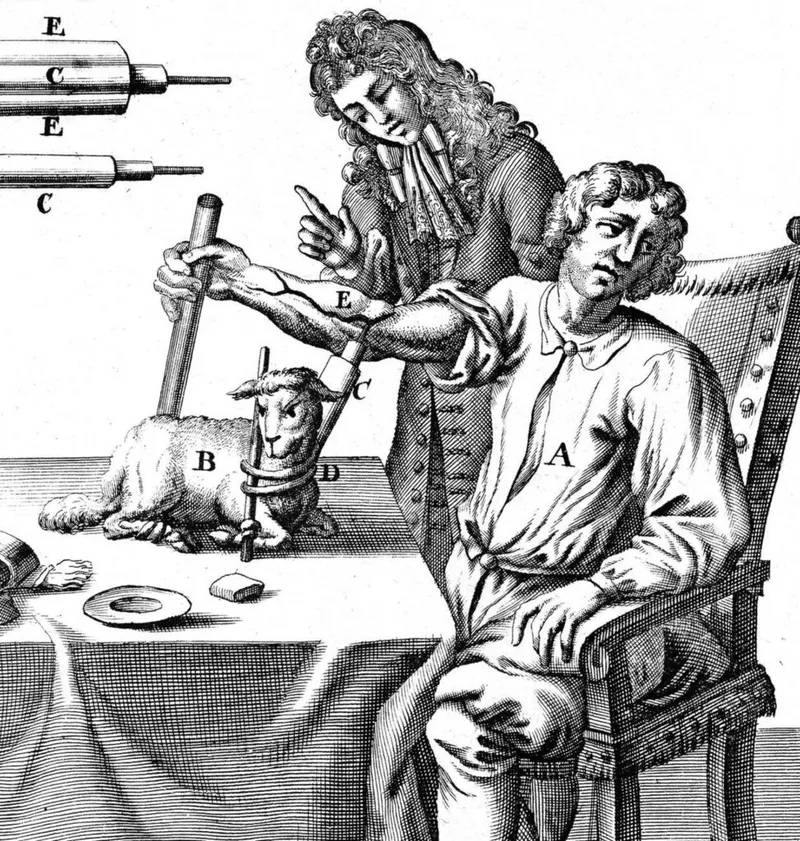 An early experimental blood transfusion where the blood of a lamb is transfused into a human, based on the work of Jean-Baptiste Denis in 1667.
