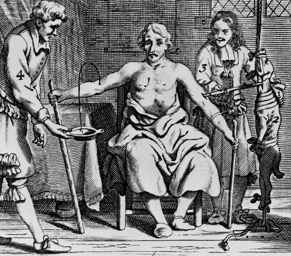 An engraving of a man receiving a blood transfusion from an animal, illustrating the experimental methods used in early transfusion history.